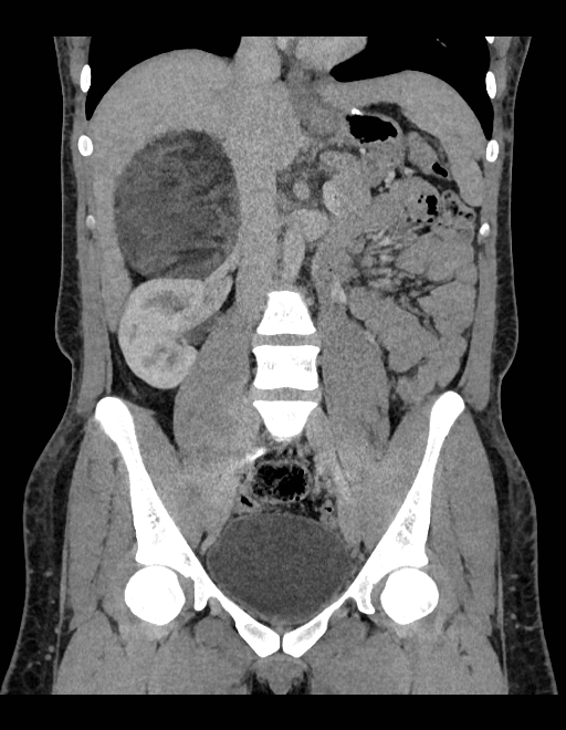 Adrenal myelolipoma - bilateral (Radiopaedia 74805-85810 Coronal C+ portal venous phase 155).jpg