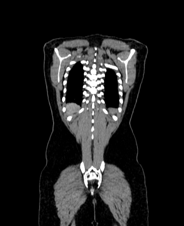 Adrenocortical carcinoma (Radiopaedia 80134-93438 Coronal C+ portal venous phase 146).jpg