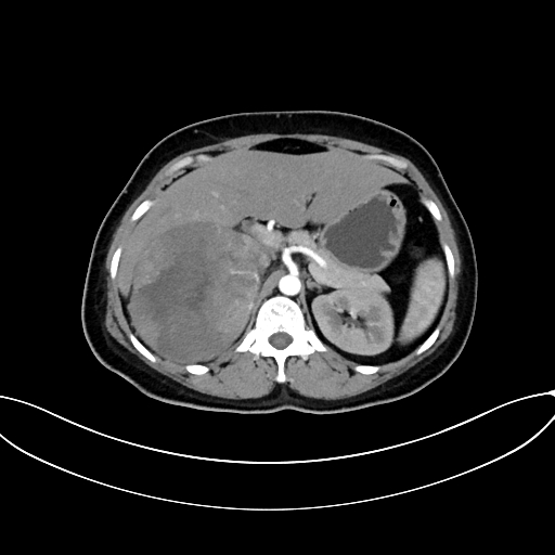 File:Adrenocortical carcinoma (Radiopaedia 87281-103569 Axial C+ arterial phase 29).jpg