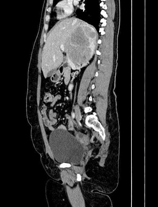 Adrenocortical carcinoma (Radiopaedia 87281-103569 Sagittal C+ portal venous phase 116).jpg