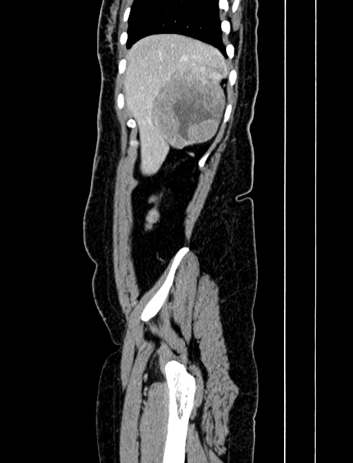 Adrenocortical carcinoma (Radiopaedia 87281-103569 Sagittal C+ portal venous phase 28).jpg