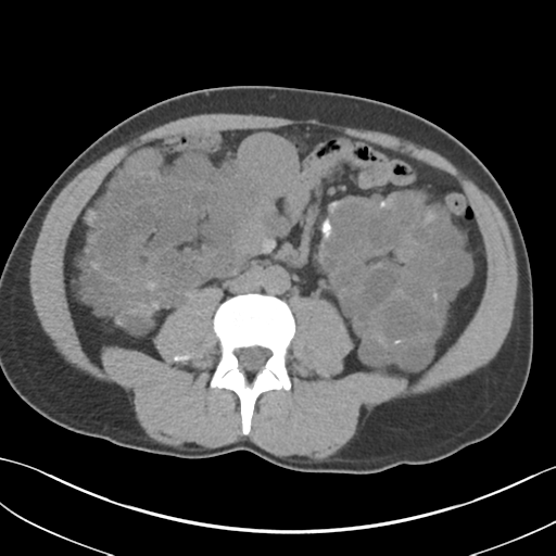 File:Adult polycystic kidney disease (Radiopaedia 47866-52626 Axial non-contrast 44).png