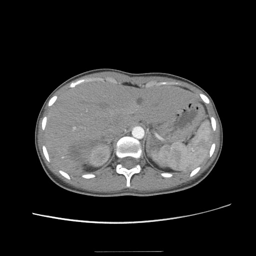 Adult polycystic kidney disease (Radiopaedia 48845-53876 Axial renal cortical phase 7).jpg