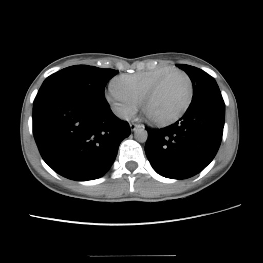 File:Adult polycystic kidney disease (Radiopaedia 48845-53876 Axial renal excretory phase 7).jpg