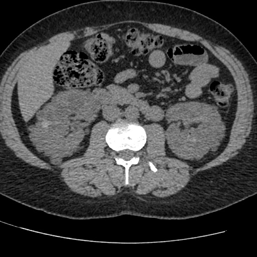 Adult polycystic kidney disease (Radiopaedia 59075-66368 Axial non-contrast 38).jpg