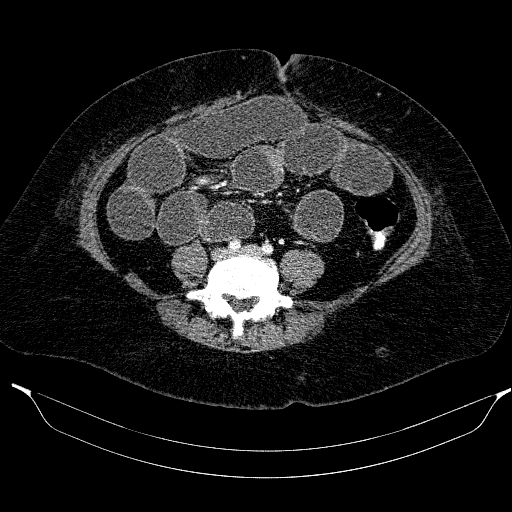 Afferent loop syndrome - secondary to incarcerated trocar site hernia (Radiopaedia 82959-97305 Axial C+ portal venous phase 157).jpg