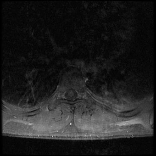 File:Aggressive vertebral hemangioma (Radiopaedia 39937-42404 Axial T1 C+ fat sat 19).png