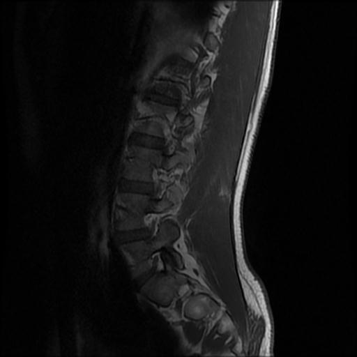 File:Aggressive vertebral hemangioma with pathological fracture (Radiopaedia 69528-79411 Sagittal T1 1).jpg