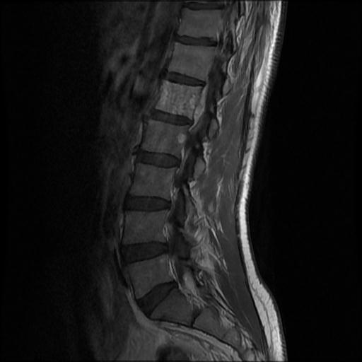 File:Aggressive vertebral hemangioma with pathological fracture (Radiopaedia 69528-79411 Sagittal T1 C+ 7).jpg