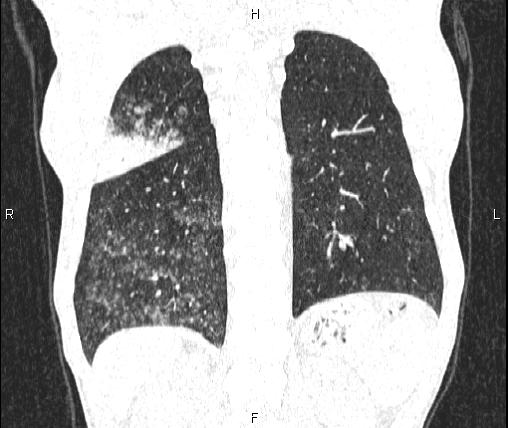 Air bronchogram in pneumonia (Radiopaedia 85719-101512 Coronal lung window 46).jpg
