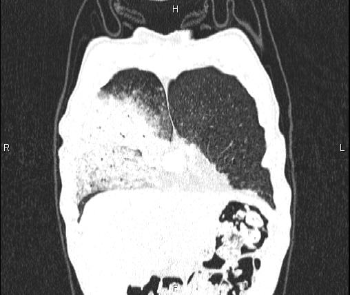 Air bronchogram in pneumonia (Radiopaedia 85719-101512 Coronal lung window 8).jpg