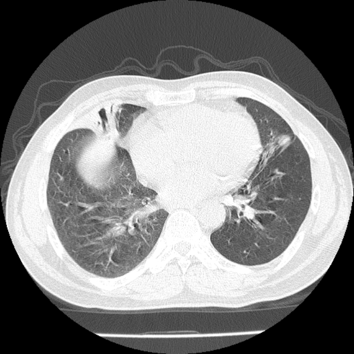 Airway foreign body in adult (Radiopaedia 85907-101779 Axial lung window 120).jpg