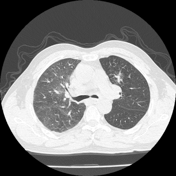 Airway foreign body in adult (Radiopaedia 85907-101779 Axial lung window 59).jpg