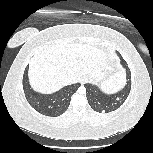 Alveolar soft part sarcoma - right leg (Radiopaedia 59432-67091 Axial lung window 95).jpg