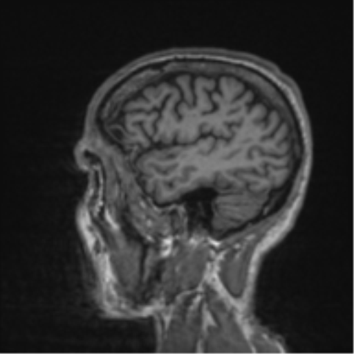 File:Alzheimer's disease- with apraxia (Radiopaedia 54763-61011 Sagittal T1 13).png