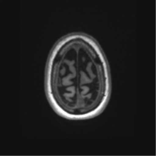 Alzheimer's disease (Radiopaedia 42658-45802 Axial T1 22).png