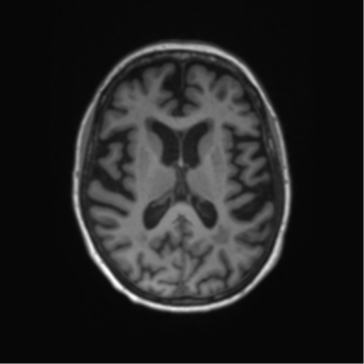 Alzheimer's disease (Radiopaedia 42658-45802 Axial T1 72).png