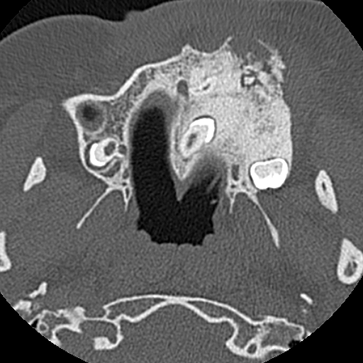 File:Ameloblastic fibro-odontoma (Radiopaedia 18843-18780 C 33).jpg