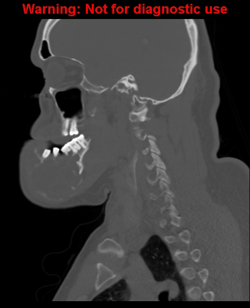 Ameloblastoma (Radiopaedia 33126-34164 Sagittal bone window 49).jpg