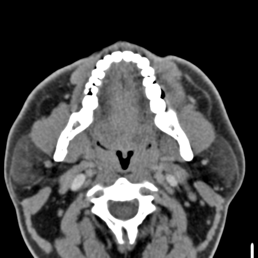 File:Ameloblastoma (Radiopaedia 33677-34806 Axial non-contrast 19).png