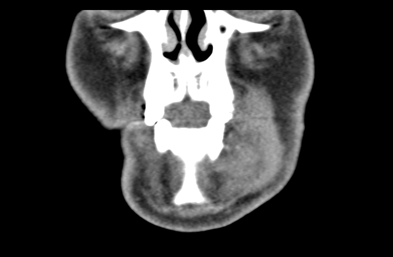 Ameloblastoma (Radiopaedia 33677-34806 Coronal non-contrast 15).png