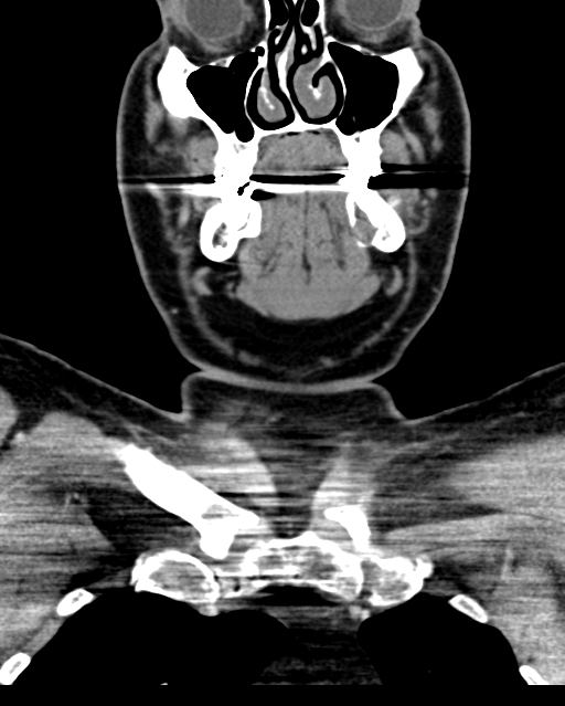 Ameloblastoma (Radiopaedia 38520-40623 Coronal non-contrast 24).png