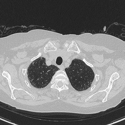 Amiodarone-induced pulmonary fibrosis (Radiopaedia 82355-96460 Axial lung window 10).jpg