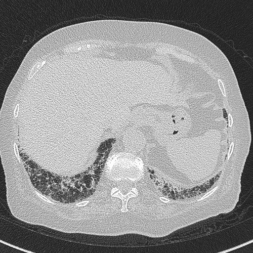 Amiodarone-induced pulmonary fibrosis (Radiopaedia 82355-96460 Axial lung window 60).jpg