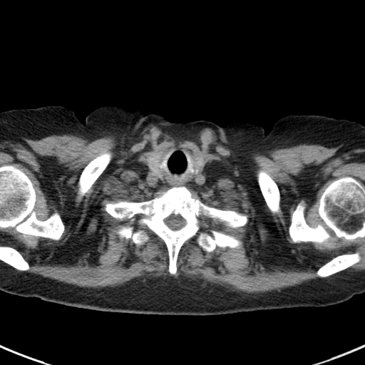 File:Amiodarone-induced pulmonary fibrosis (Radiopaedia 82355-96460 Axial non-contrast 6).jpg