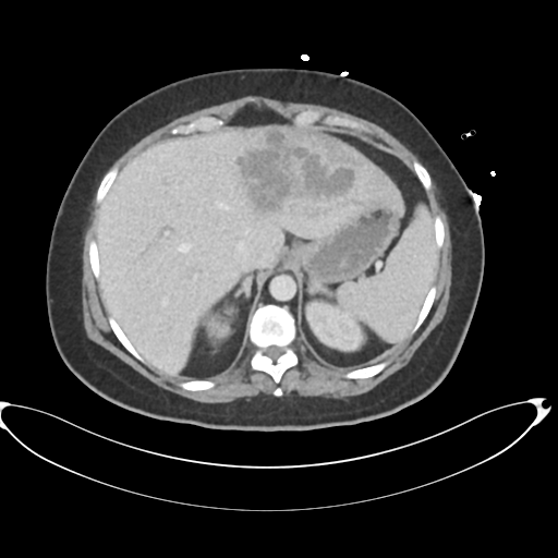 File:Amoebic liver abscess (Radiopaedia 52611-58530 A 21).png