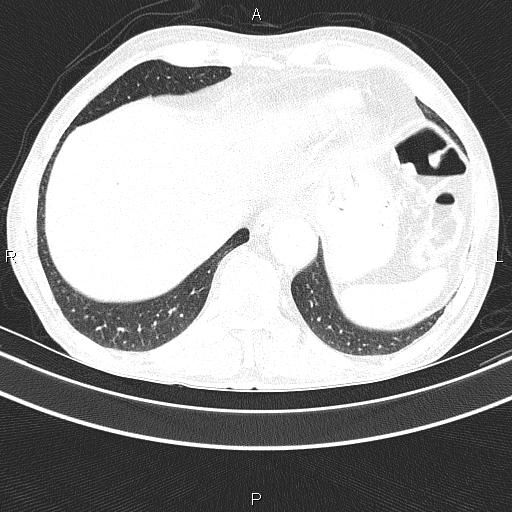Ampullary adenocarcinoma (Radiopaedia 86093-102033 Axial lung window 48).jpg