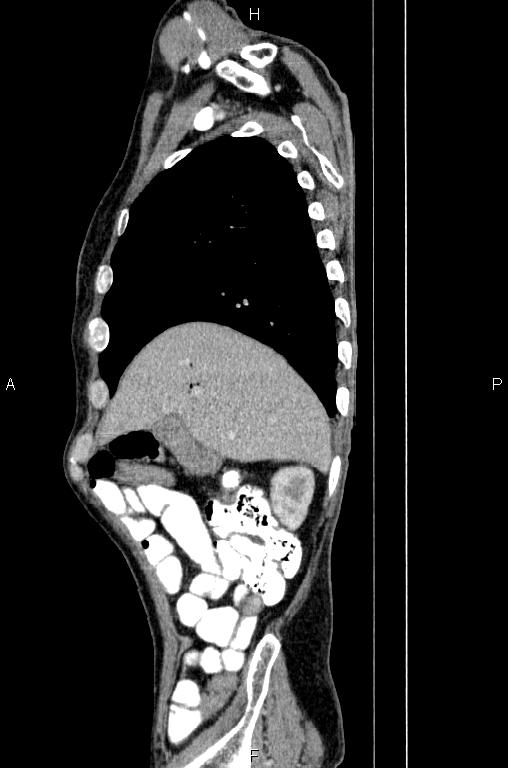 Ampullary adenocarcinoma (Radiopaedia 86093-102033 E 18).jpg