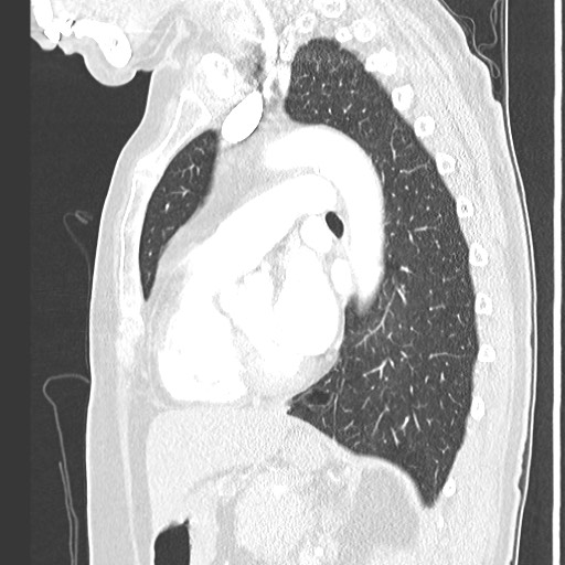 Amyloidosis - bronchial and diffuse nodular pulmonary involvement (Radiopaedia 60156-67745 Sagittal lung window 54).jpg