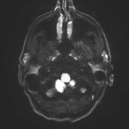 Amyotrophic lateral sclerosis (Radiopaedia 87352-103658 Axial DWI 29).jpg
