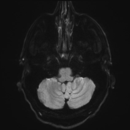 Amyotrophic lateral sclerosis (Radiopaedia 87352-103658 Axial DWI 32).jpg