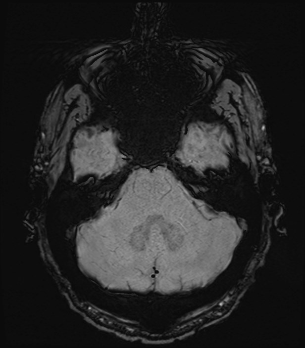 Amyotrophic lateral sclerosis (Radiopaedia 87352-103658 Axial SWI 9).jpg