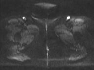 Anal adenocarcinoma - tumor regression grade 1 (Radiopaedia 31358-32101 Axial DWI 3).jpg