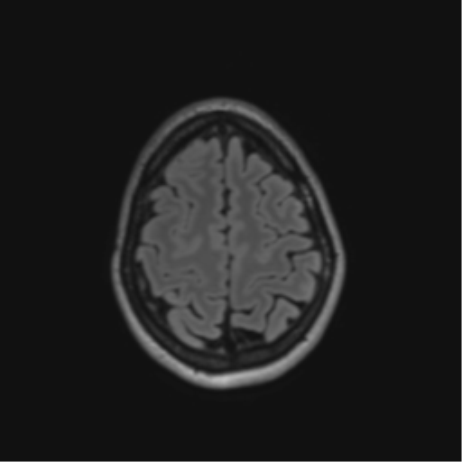 File:Anaplastic astrocytoma IDH mutant (Radiopaedia 50046-55341 Axial FLAIR 41).png
