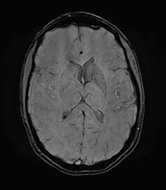 File:Anaplastic astrocytoma IDH mutant (Radiopaedia 50046-55341 Axial SWI 49).png