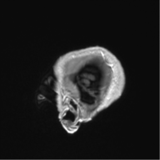 Anaplastic astrocytoma IDH mutant (Radiopaedia 50046-55341 Sagittal T1 C+ 10).png