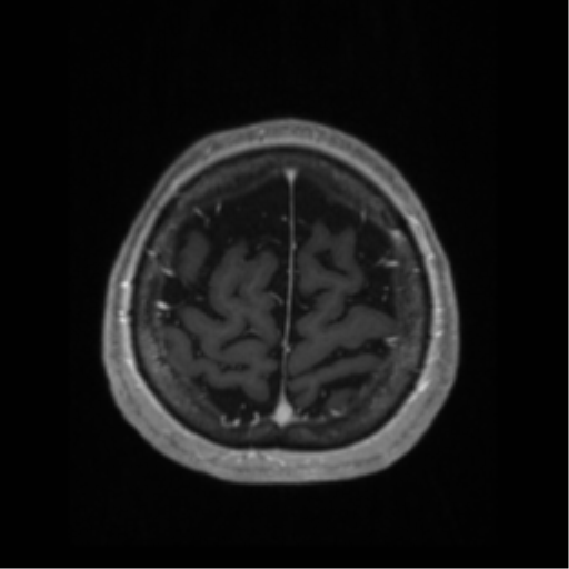 Anaplastic astrocytoma IDH wild-type (pseudoprogression) (Radiopaedia 42209-45276 Axial T1 C+ 127).png