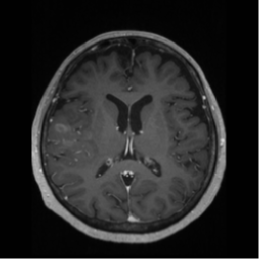 File:Anaplastic astrocytoma IDH wild-type (pseudoprogression) (Radiopaedia 42209-45276 Axial T1 C+ 85).png