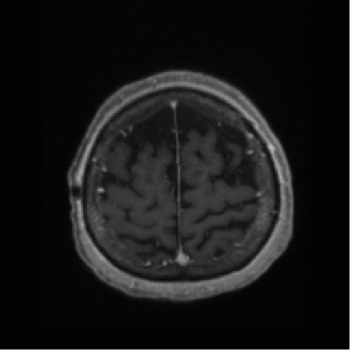 File:Anaplastic astrocytoma IDH wild-type (pseudoprogression) (Radiopaedia 42209-45277 Axial T1 C+ 109).png