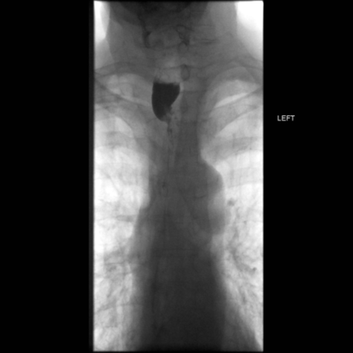File:Anastomotic stricture post Ivor Lewis esophagectomy (Radiopaedia 47937-52715 Frontal 27).png