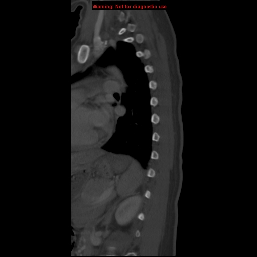 File:Aneurysmal bone cyst (Radiopaedia 9419-10102 Sagittal bone window 18).jpg