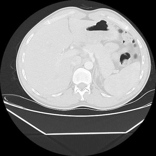 Aneurysmal bone cyst - rib (Radiopaedia 82167-96220 Axial lung window 63).jpg