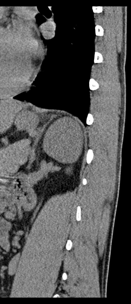 Aneurysmal bone cyst T11 (Radiopaedia 29294-29721 E 14).jpg