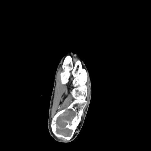 File:Aneurysmal bone cyst of the calcaneus (Radiopaedia 60669-68421 A 31).jpg