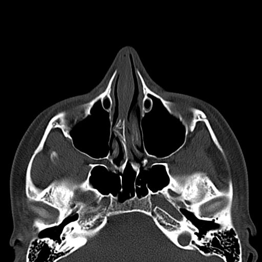 File:Aneurysmal bone cyst of the mandible (Radiopaedia 43280-46601 Axial bone window 80).jpg