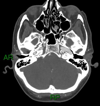 File:Aneurysmal subarachnoid hemorrhage with intra-axial extension (Radiopaedia 84371-99732 A 43).jpg